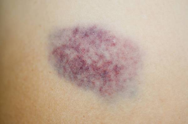 علت کبودی‌های بی دلیل چیست؟