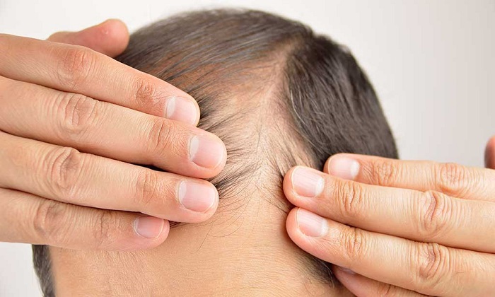 آیا ریزش موی مرتبط با دیابت است؟+ دلایل و درمان