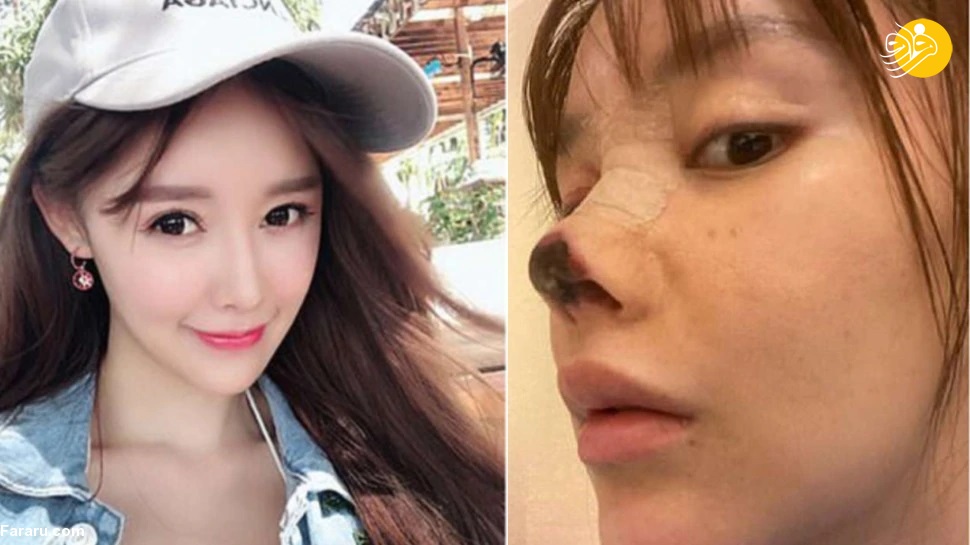 فاجعه عمل جراحی ناموفق روی بینی خانم بازیگر! + عکس