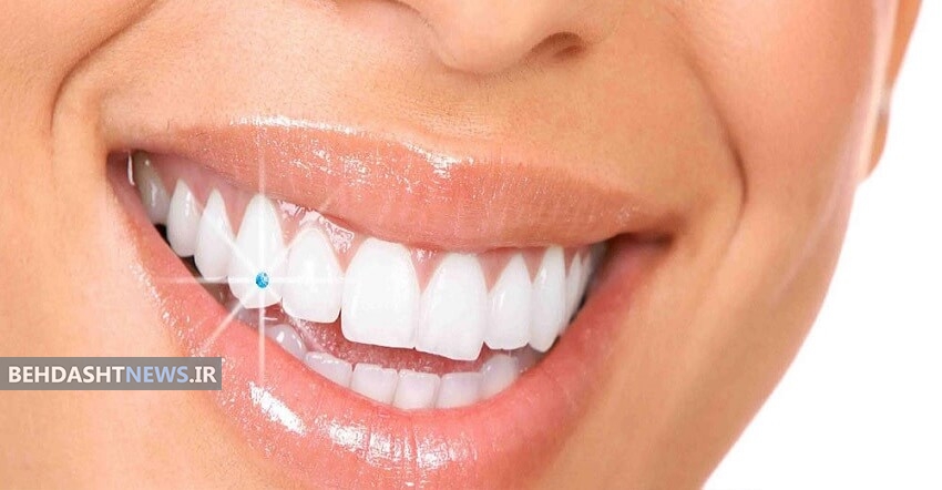 عوارض کاشتن نگین بر روی دندان ها