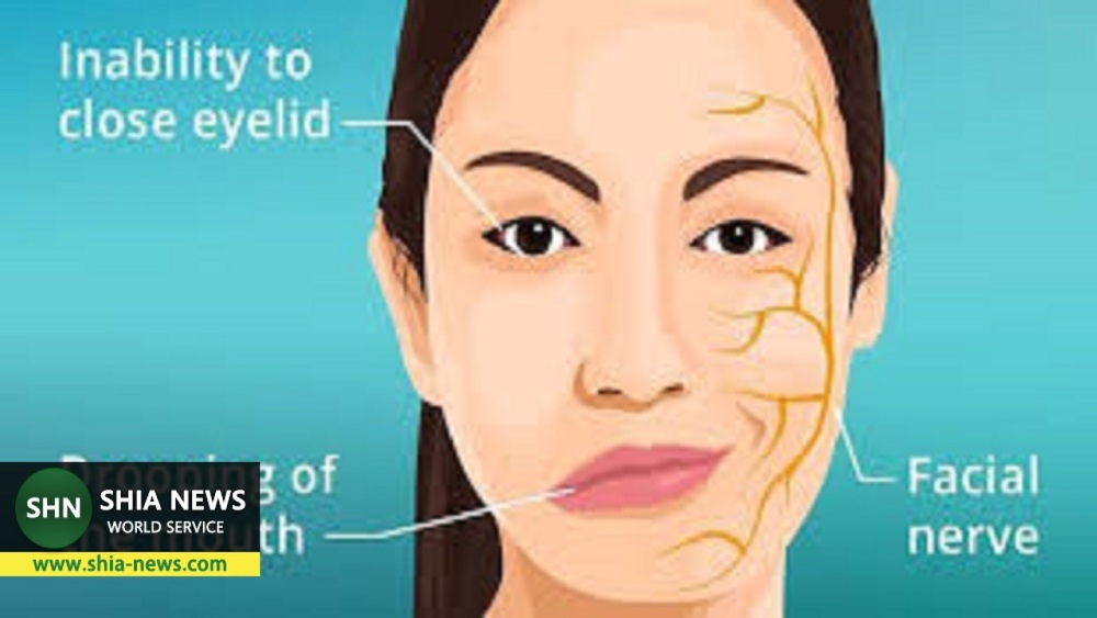 بیماری که باعث فلج عضلات صورت می‌شود