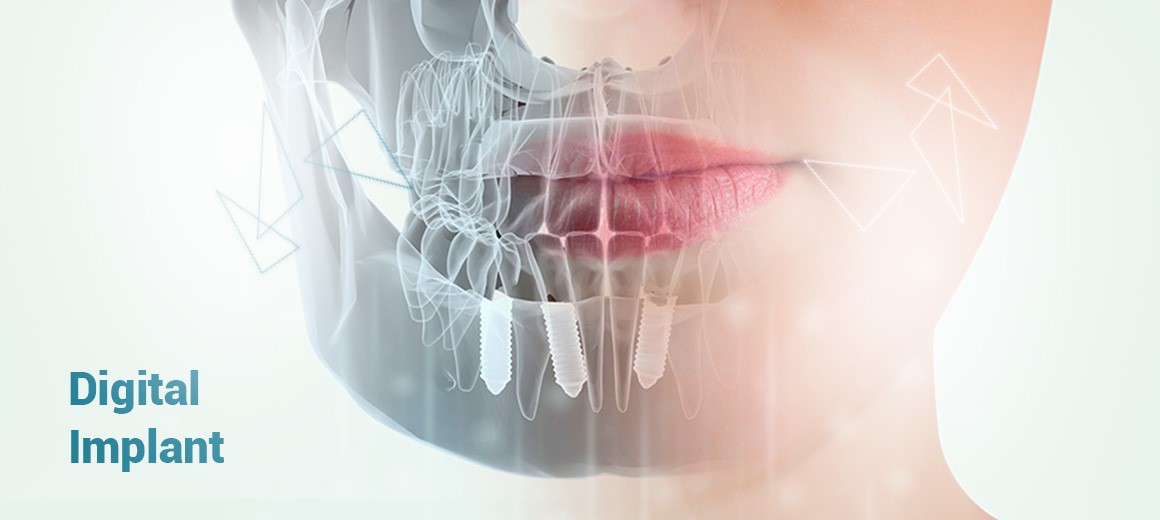 آیا ایمپلنت دیجیتال روشی دائمی برای کاشت دندان است ؟