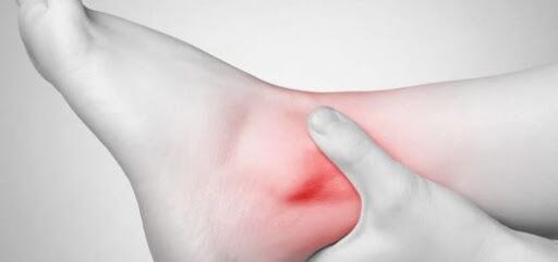 رگ‌های واریسی دارید، این باورهای غلط را کنار بگذارید