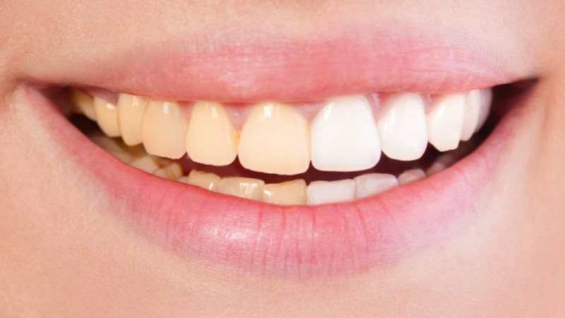 چرا دندان تغییر رنگ می دهد؟