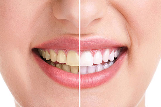 ۷ روش طبیعی برای سفید کردن دندان‌ها  