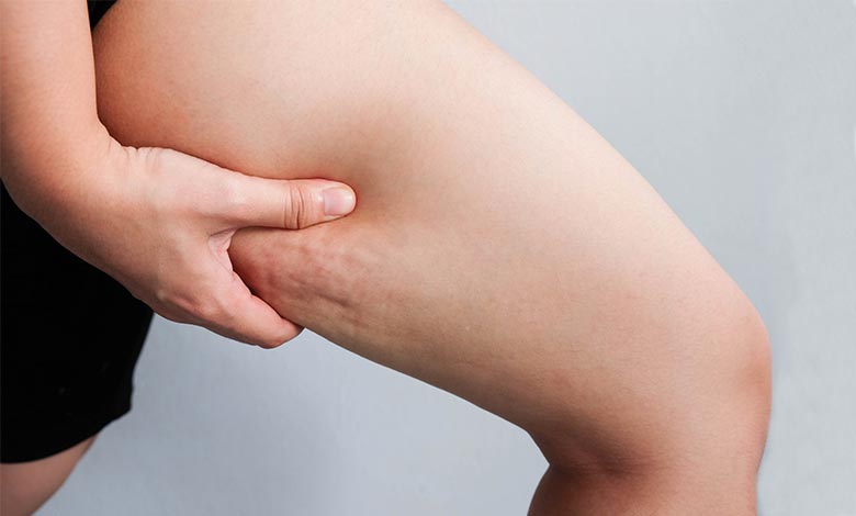  سلولیت چیست و چگونه می توان آن را درمان کرد؟