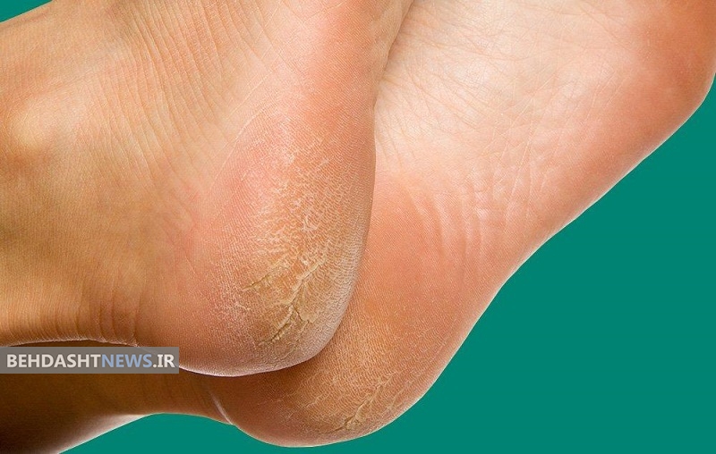  ۷ دلیل ترک خوردن پاشنه پاها 