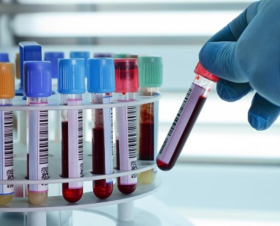 چطور نتیجه آزمایش چربی خون را تفسیر کنیم؟