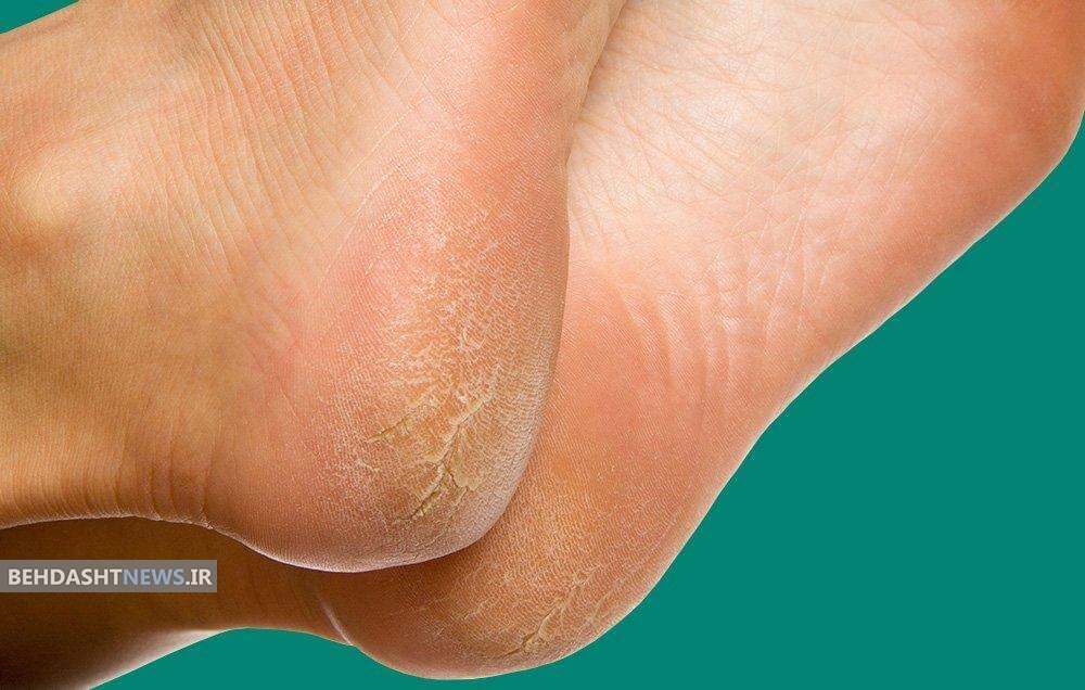  ۷ دلیل ترک خوردن پاشنه پاها 