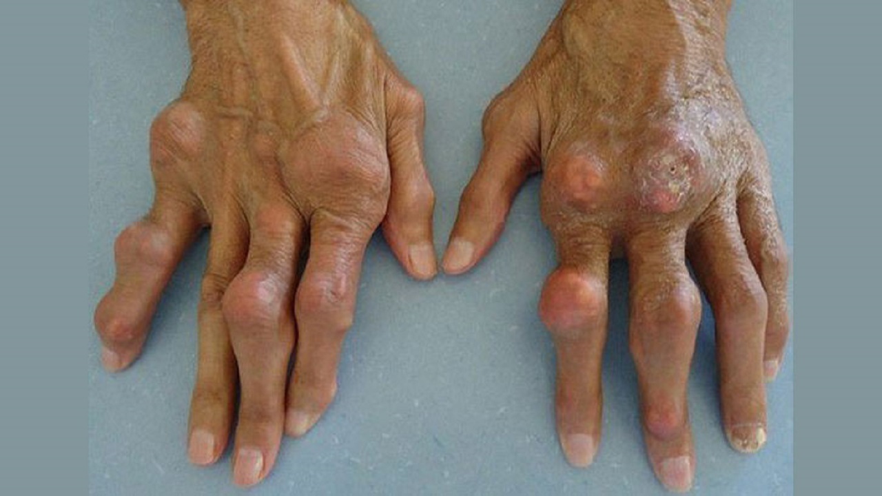 علامتی که می گوید به نقرس مبتلا شده اید + راههای درمان 