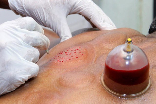  پزشک طب سنتی: کرونایی‌ ها با تشخیص پزشک «حجامت» کنند