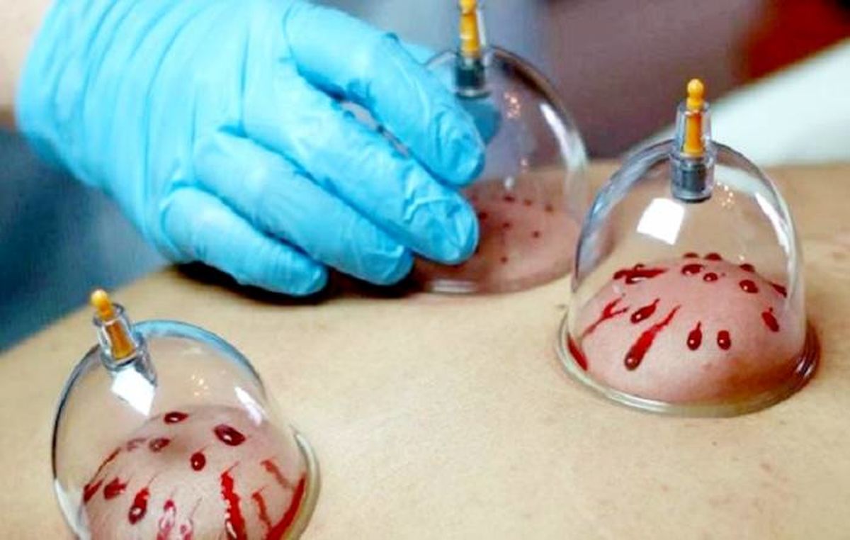 کرونایی‌ها می‌توانند حجامت کنند؟