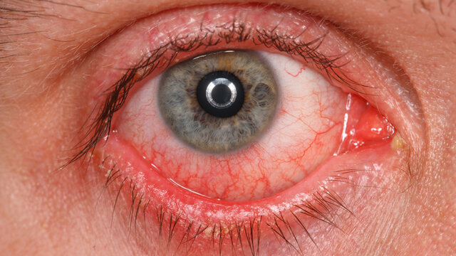  ابتلای سلول‌های چشم به کووید-۱۹