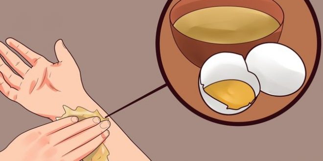 راهکار طب سنتی برای رفع سوختگی پوست با آب یا اجسام داغ 