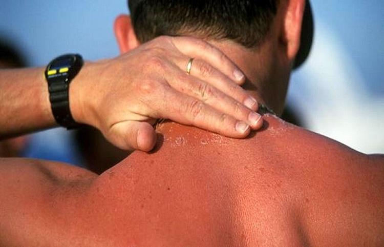  کدام قسمت‌های بدن از آفتاب‌سوختگی مصون نمی‌مانند؟