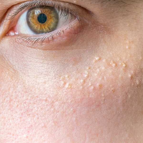 میلیا چیست؟+ درمان