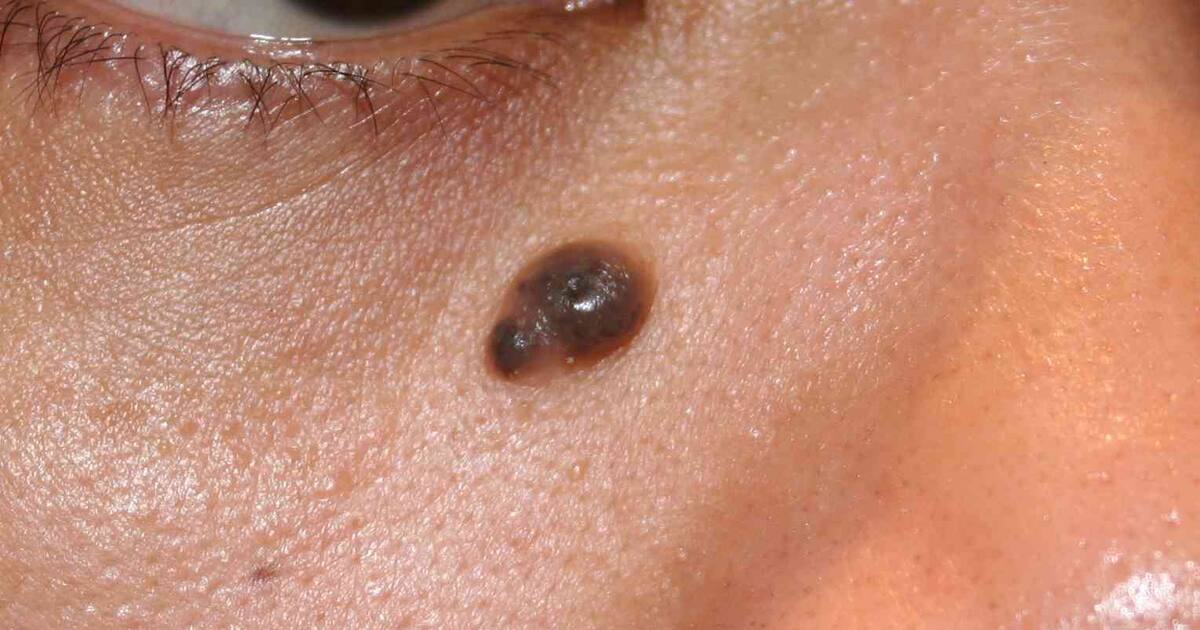 علت خارش خال چیست؟