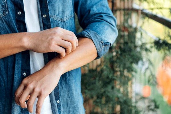 چند راهکار برای از بین بردن خارش جای نیش پشه