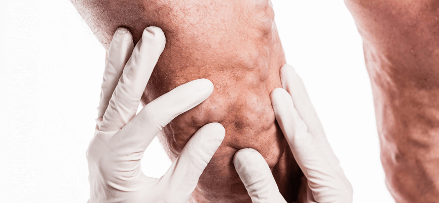 علت ایجاد رگ های واریسی + راه درمان 