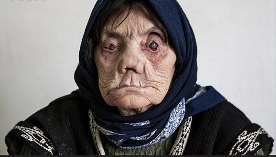 جزامی‌های ایران کجا زندگی می‌کنند؟