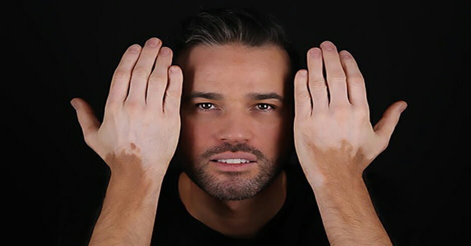 این بیماری به ظاهر شما صدمه میزند