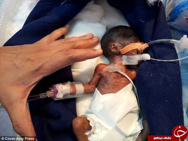 کوچکترین نوزاد جهان به اندازه کف دست + عکس