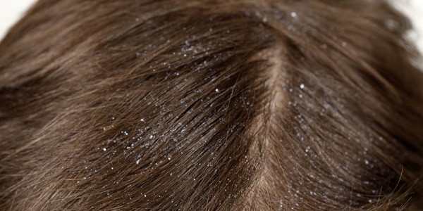 هر آن‌چه در مورد شپش موی سر باید بدانیم