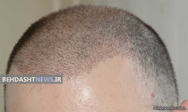  کاشت مو در مراکز غیر تخصصی ممنوع