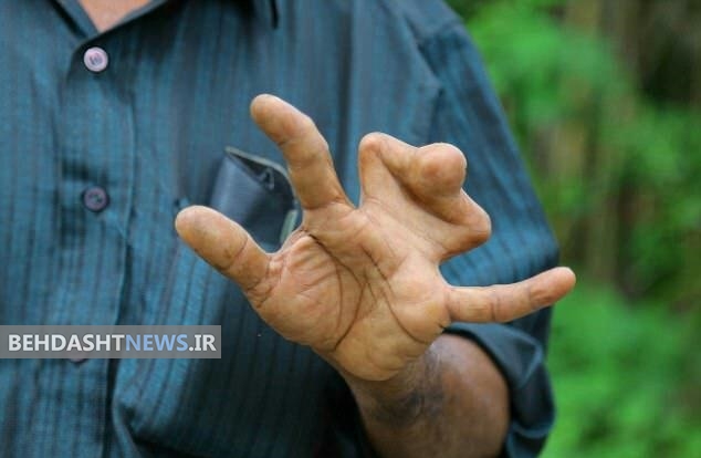  عروس و دامادهای این قبیله بخاطر یک اختلال ژنتیکی نمی‌توانند انگشتر در دست کنند/ببینید