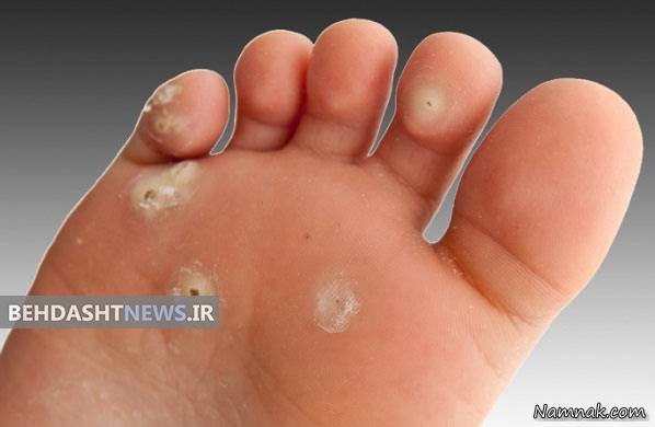 میخچه پا و روش های درمان خانگی آن 