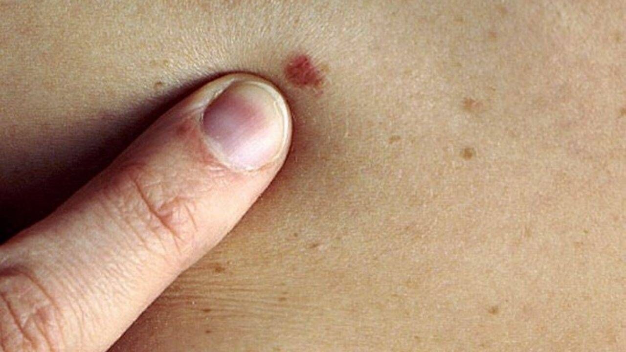 پوست روشن و موهای قرمز مستعد سرطان است