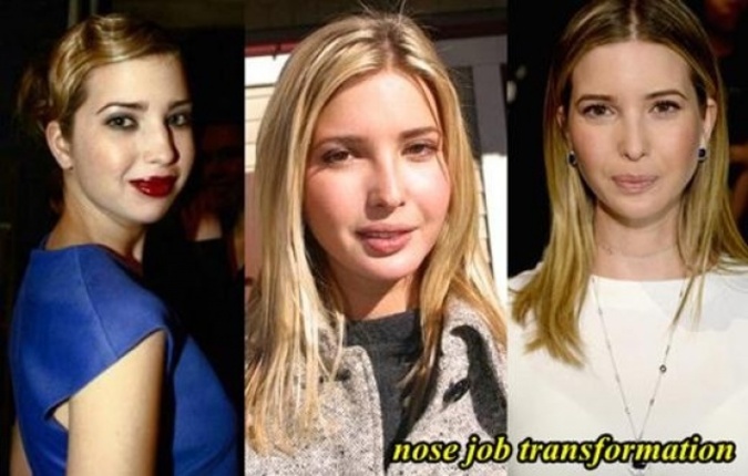 «ایوانکا ترامپ» قبل و بعد از عمل زیبایی‌ + تصا‌ویر