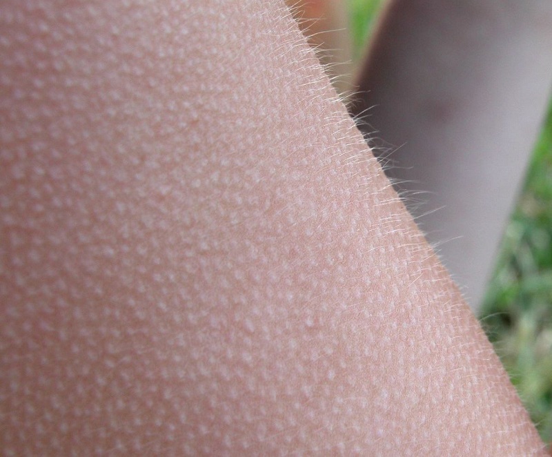 اینفوگرافیک/ عارضه پوست مرغی چیست؟+ راه‌های کنترل