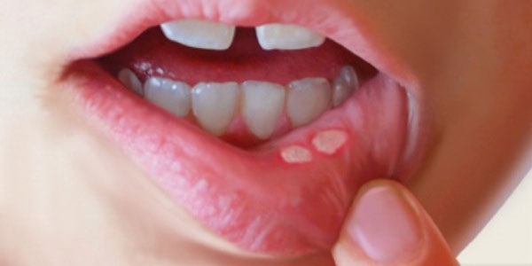 درمان سریع آفت دهان بدون دارو 