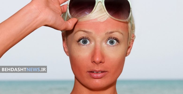 ۱۲ درمان طبیعی برای آفتاب‌سوختگی