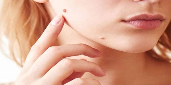 زگیل پوستی منجر به سرطان می‌شود؟