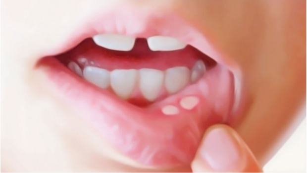  درمان آفت دهان با گیاهان دارویی