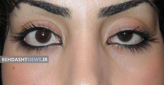  پیشگیری از افتادگی پلک با این روش ها 