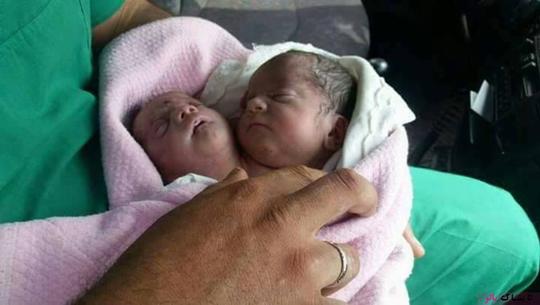 تولد عجیب نوزاد دو سر در سوریه + عکس
