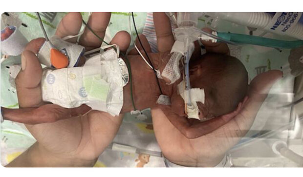 نارس ترین نوزاد جهان که زنده ماند+عکس