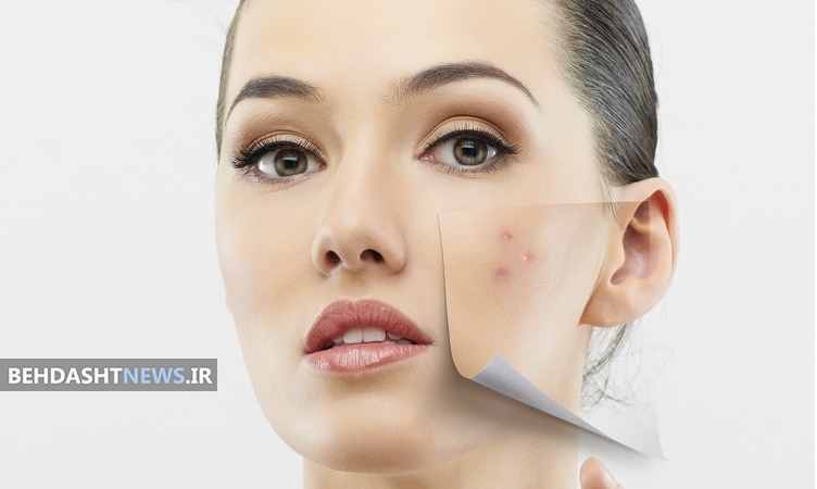 ترفندهایی برای پیشگیری از جوش صورت