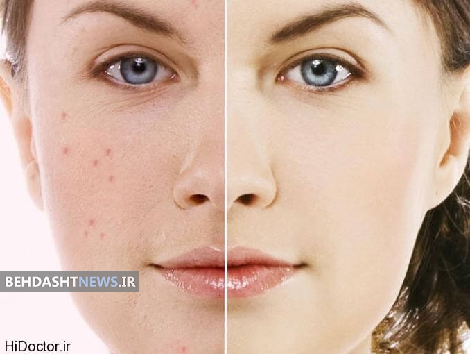 از بین بردن جای جوش صورت با جوش شیرین 