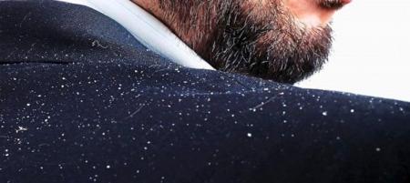  از شوره سر زمستانی چه می دانید؟