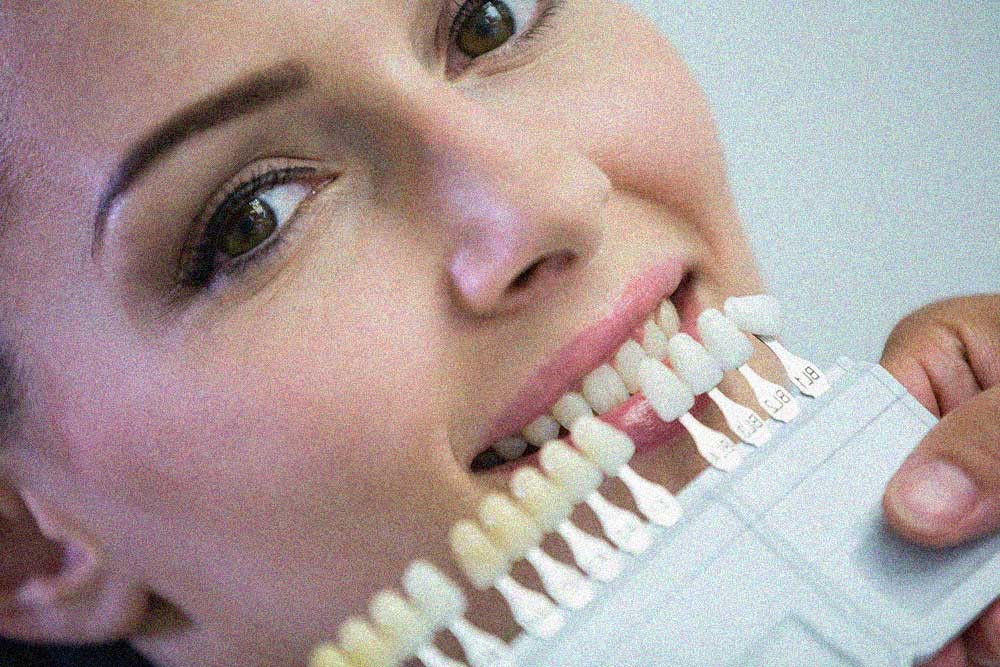مقدار تراش دندان برای لمینت در چه حدی است؟