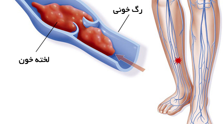 10  نشانه وجود لخته خون در پا