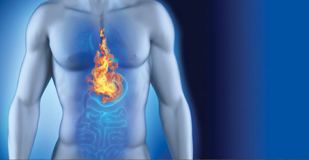 درمان التهاب مری در اثر ریفلاکس