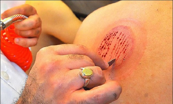 چه افرادی اجازه حجامت کردن دارند؟