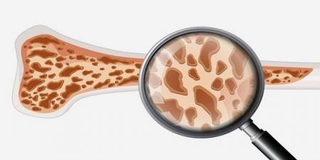 راهکارهای گریز از پوکی استخوان، بیماری قرن