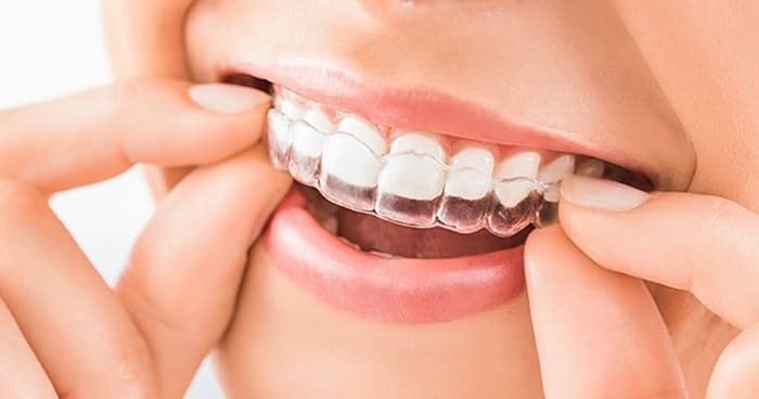 محافظ دندان برای این افراد ضروریست