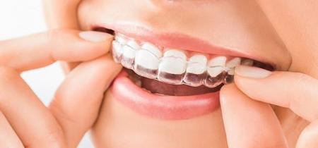 محافظ دندان برای این افراد ضروریست